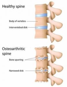 Spinal Osteoarthritis