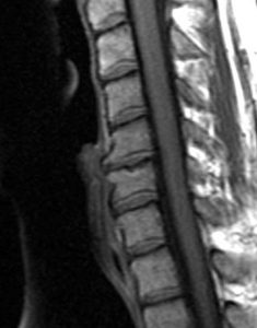 Cervical Degenerative Disc Disease