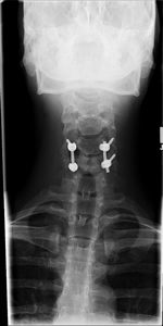 Posterior Lumbar Interbody Fusion