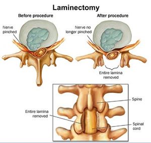 Laminectomy