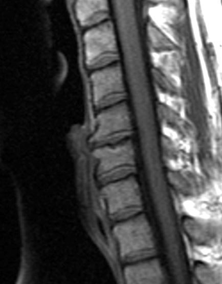Cervical Degenerative Disc Disease - Degenerative Disc Treatment